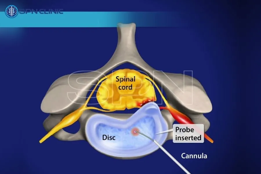 nükleoplasti tedavisi