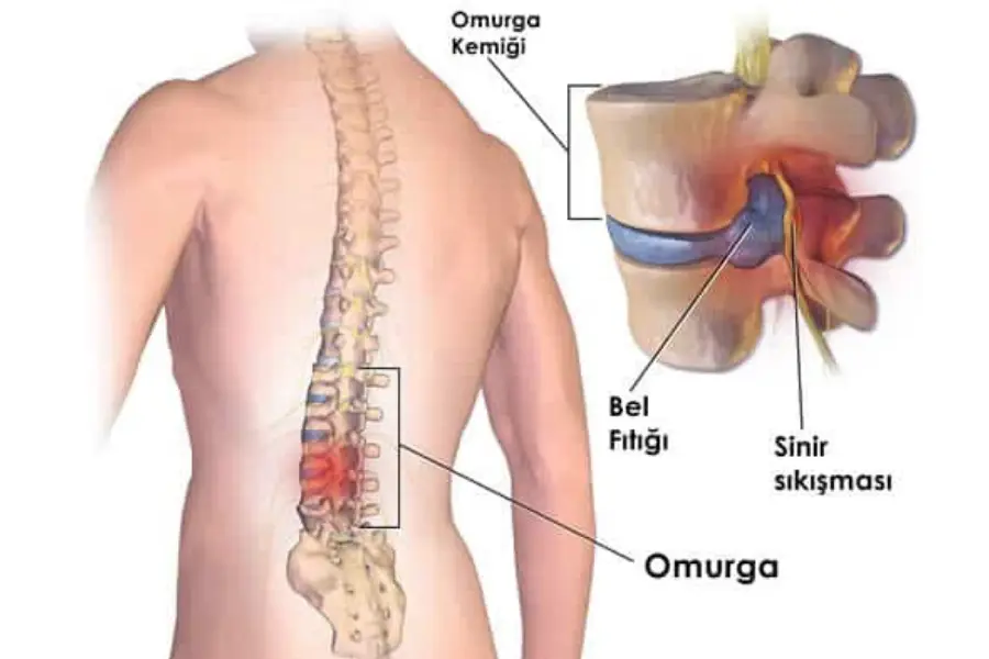 ameliyatsız bel fıtığı tedavisi fiyatları