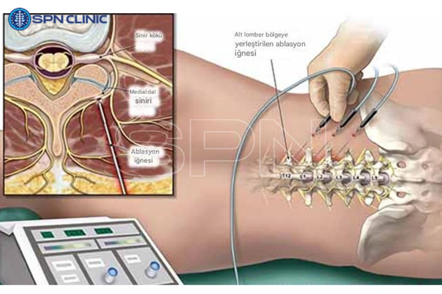 iğneli radyofrekans