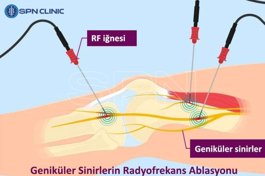 Radyofrekans Ablasyon Cihazları