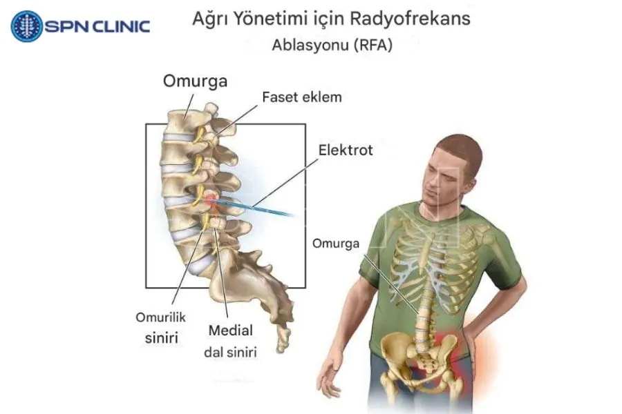 radyofrekans ablasyon yan etkileri