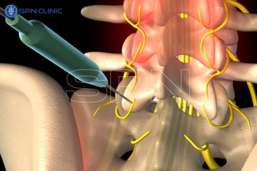 radyofrekans ablasyon yan etkileri